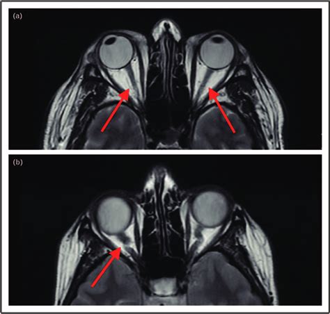 optic nerve thickness measurement mri|optic nerve different sizes.